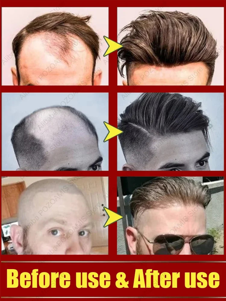 98% of buyers buy again, have more and more hair, say goodbye to baldness, thick hair,Hot selling product