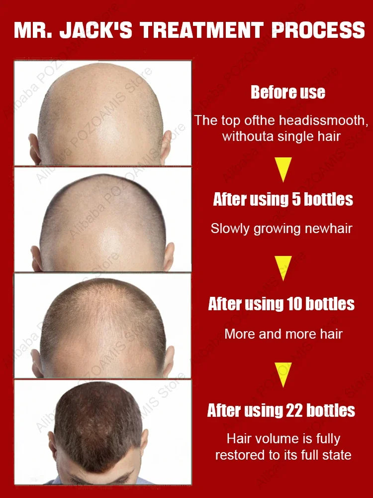 98% of buyers buy again, have more and more hair, say goodbye to baldness, thick hair,Hot selling product